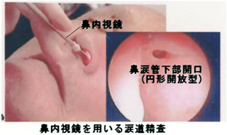 鼻内視鏡を用いる涙道検査