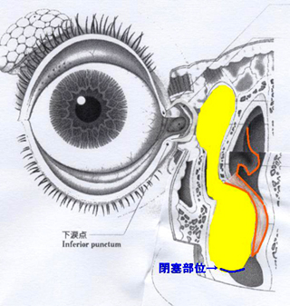 流涙症(なみだ目)(小児編)