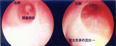 図5:内視鏡的蛍光色素排出テスト