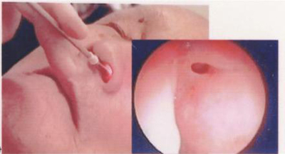 図2:内視鏡的涙道洗浄